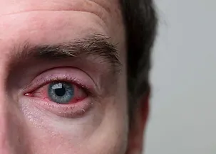 Conjunctivitis